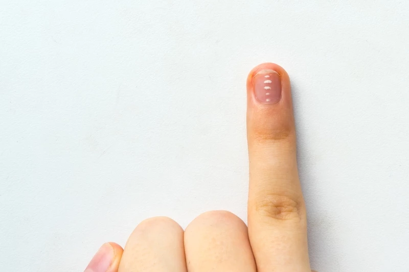 У ребенка белые пятна на ногтях