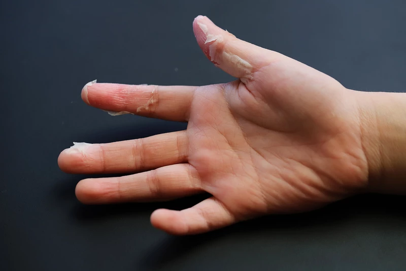 У ребенка облазит кожа на пальцах?