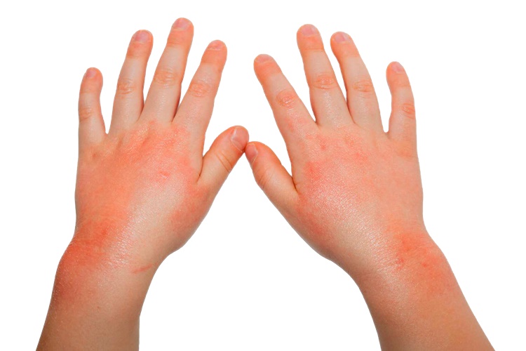 Как лечить атопический дерматит у детей?
