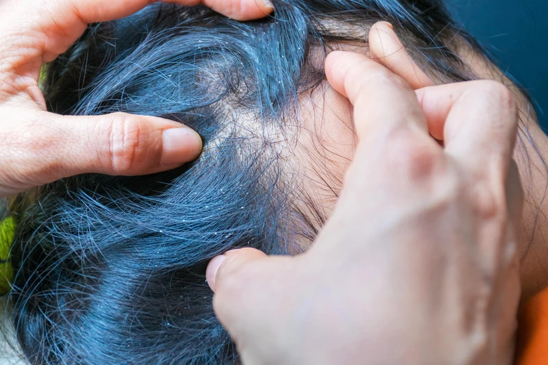 У ребенка вши: симптомы и лечение