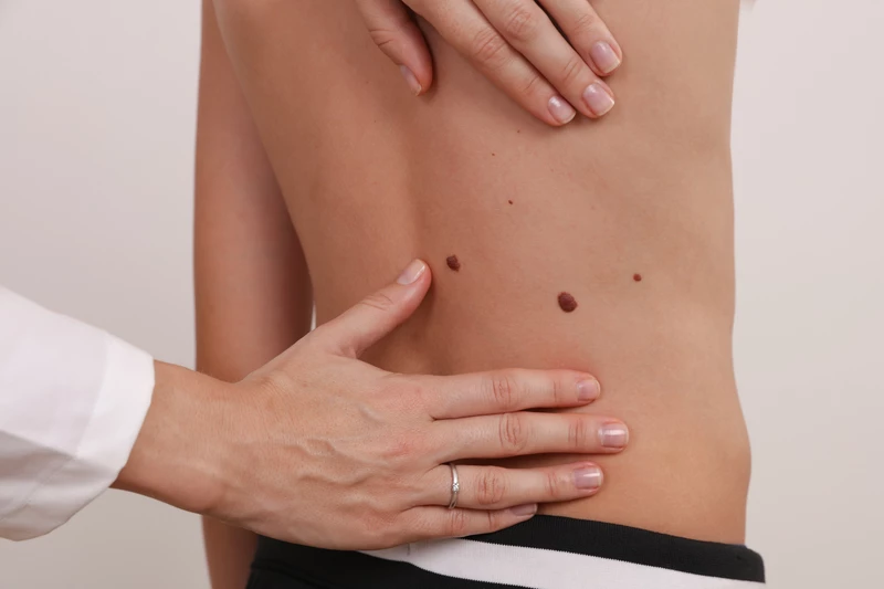 Родинки у детей: все что надо знать родителям