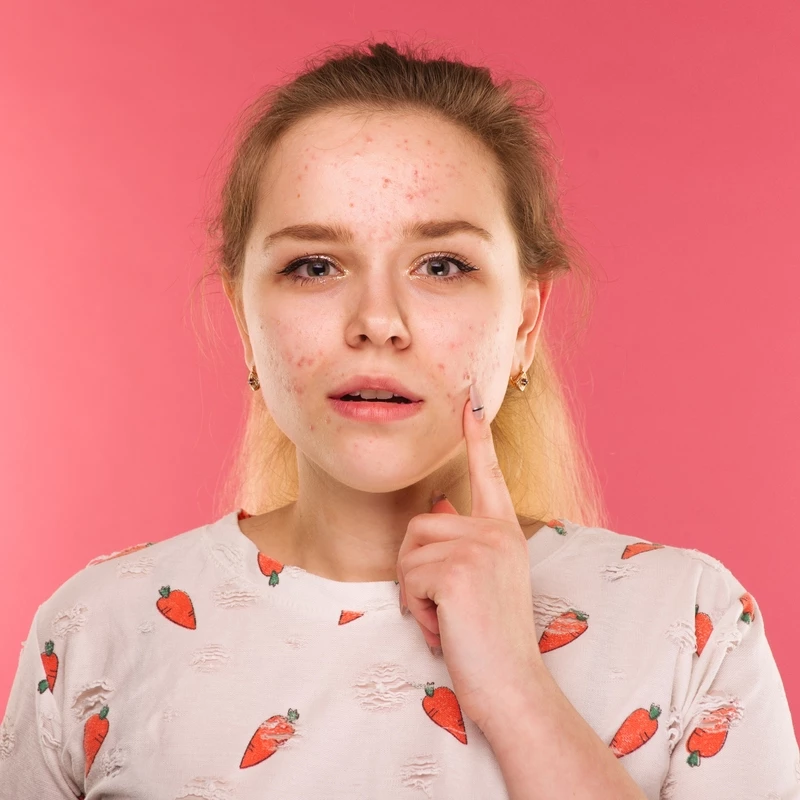 Акне у подростков: причины и методы лечения