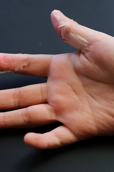 У ребенка облазит кожа на пальцах?