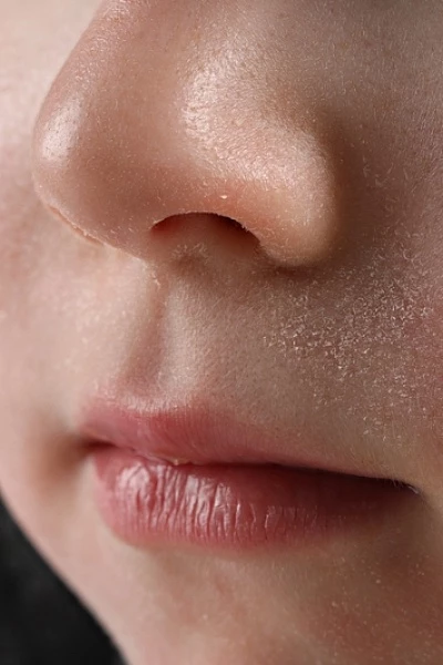 У ребенка сухая кожа: причины и лечение