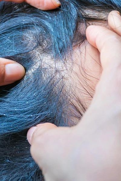 У ребенка вши: симптомы и лечение