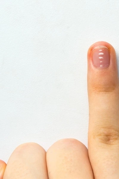 У ребенка белые пятна на ногтях