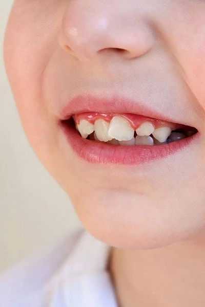 Что делать, если у ребенка криво растут зубы?