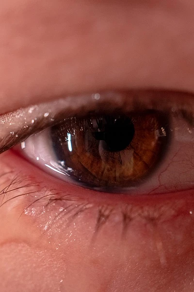 У ребенка слезятся глаза: причины и лечение