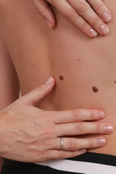 Родинки у детей: все что надо знать родителям