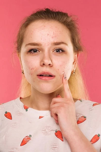 Акне у подростков: причины и методы лечения