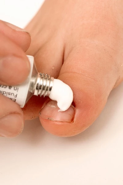 Грибок ногтей у ребенка: что надо делать родителям