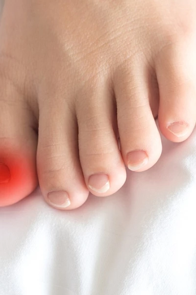 Вросший ноготь у ребенка: причины и лечение